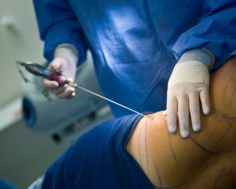 A doctor performing a Liposuction surgery in Bangkok