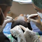 two doctors from Thailand preforming an hair transplant procedures