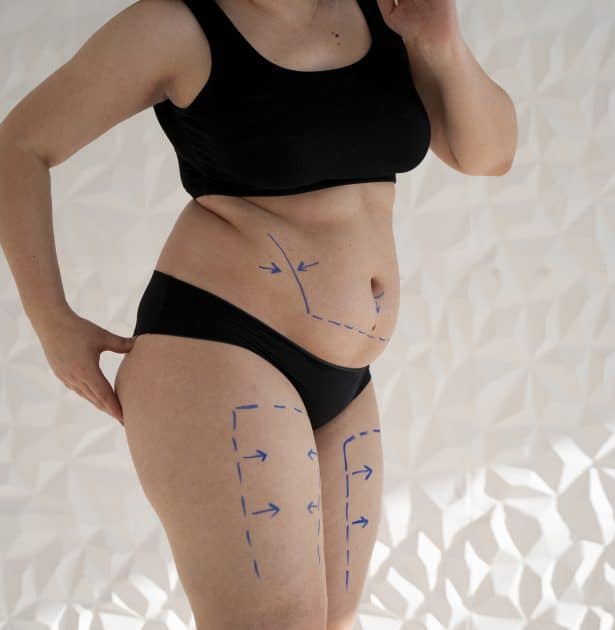 A Comprehensive Guide to Liposuction in Thailand