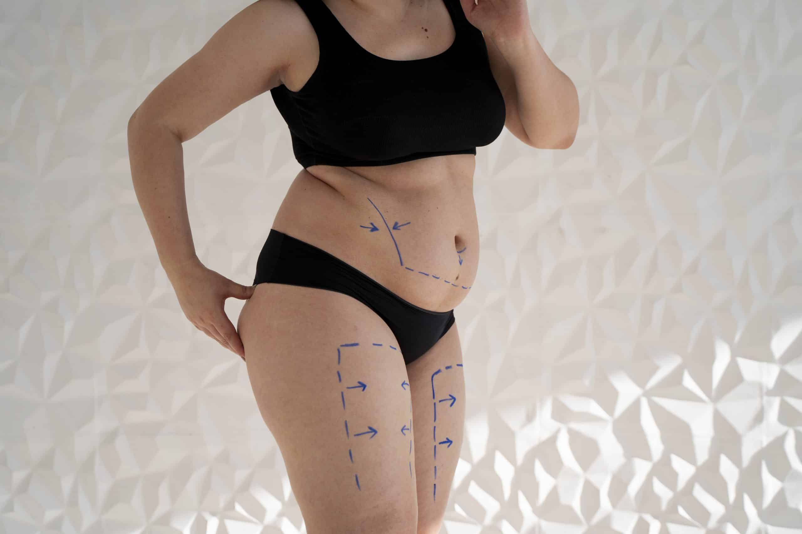 A Comprehensive Guide to Liposuction in Thailand