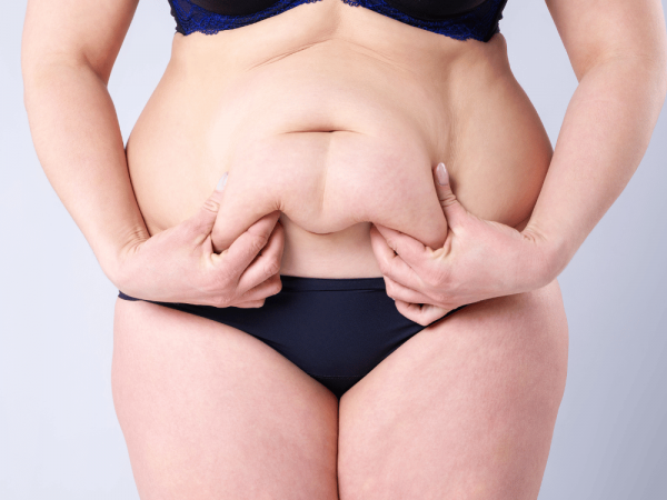 Tummy tuck, flabby skin on a fat belly, plastic surgery concept